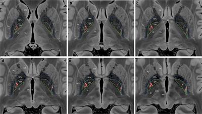 Globus Pallidus Internus Deep Brain Stimulation for Dystonic Opisthotonus in Adult-Onset Dystonia: A Personalized Approach